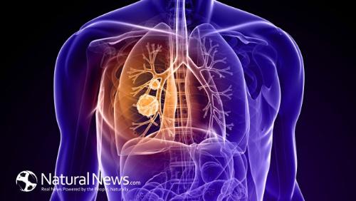 bệnh ung thư phổi sẽ giết phổi bạn