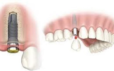 nguyên nhân dẫn đến rụng răng sớm